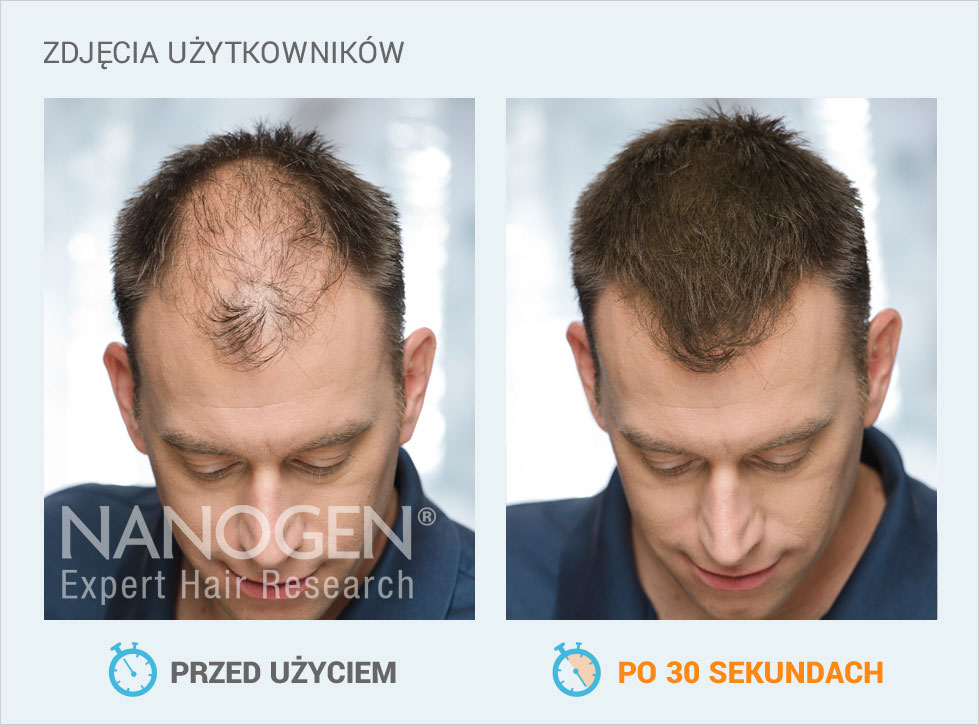 Najskuteczniejsze preparaty na porost włosów : NANOGEN.PL