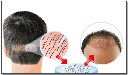 grafika przeszczepu włosów